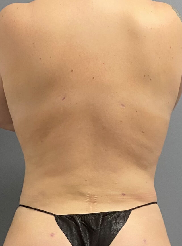 Case--9845 | After Liposuction
