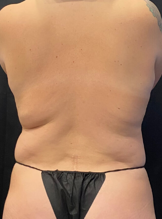 Case--9845 | Before Liposuction