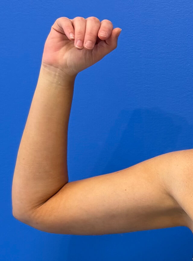 Case--7812 | After Liposuction