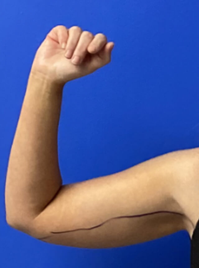 Case--7812 | Before Liposuction