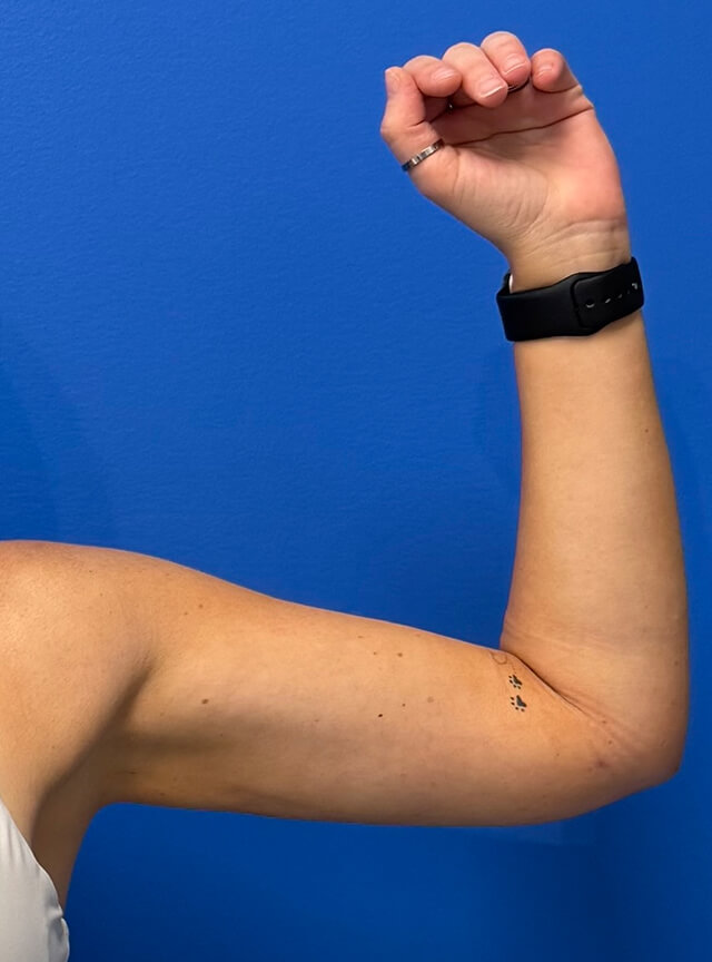 Case--7812 | After Liposuction 2