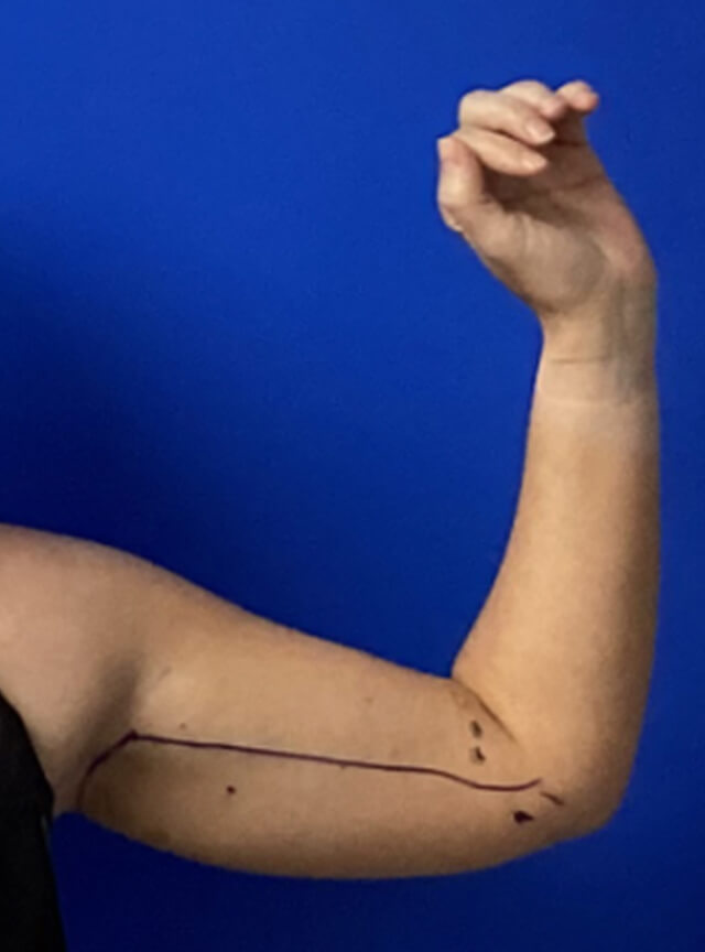 Case--7812 | Before Liposuction 2