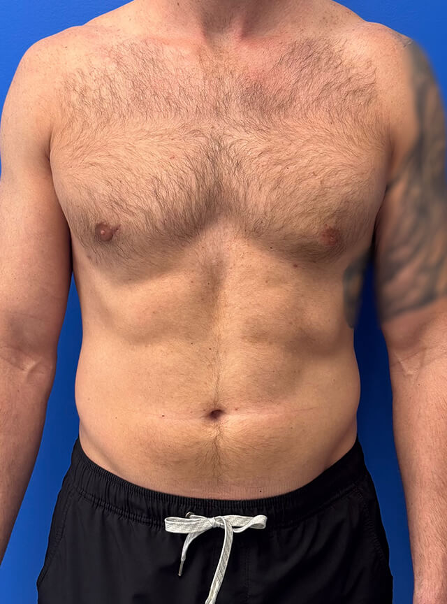 Case--5192 | After Male Plastic Surgery