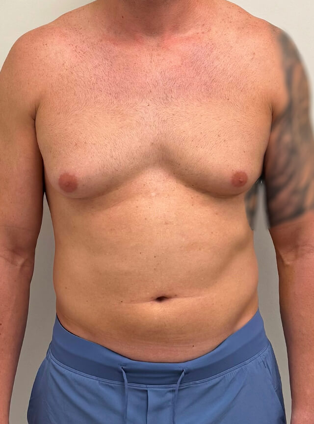 Case--5192 | Before Male Plastic Surgery