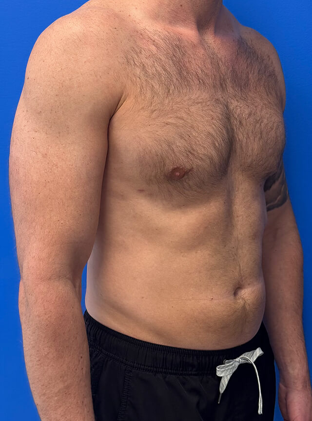 Case--6984 | After Gynecomastia 2