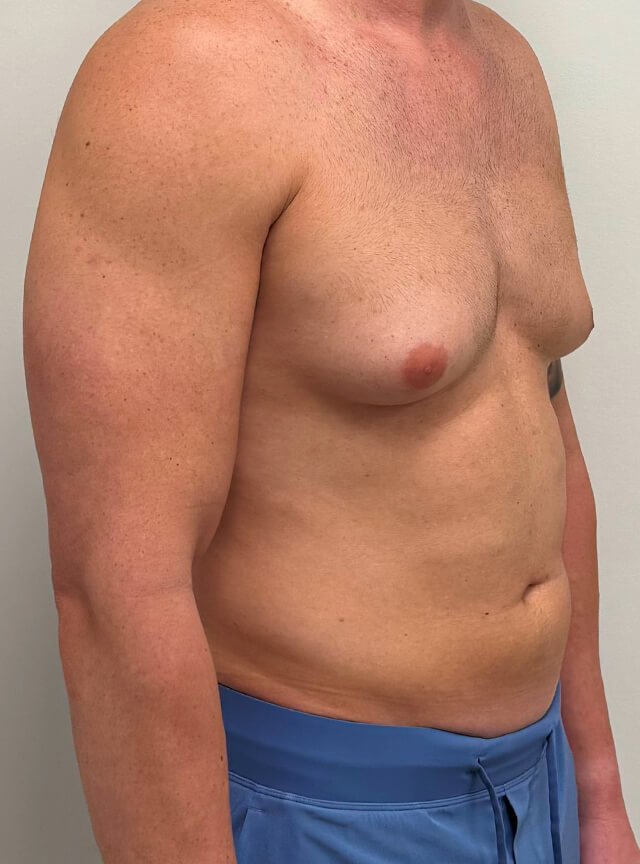 Case--6984 | Before Gynecomastia 2