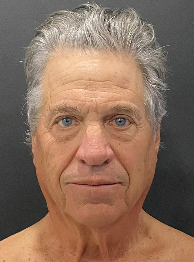 Case--6178 | Before Facelift and Neck Lift