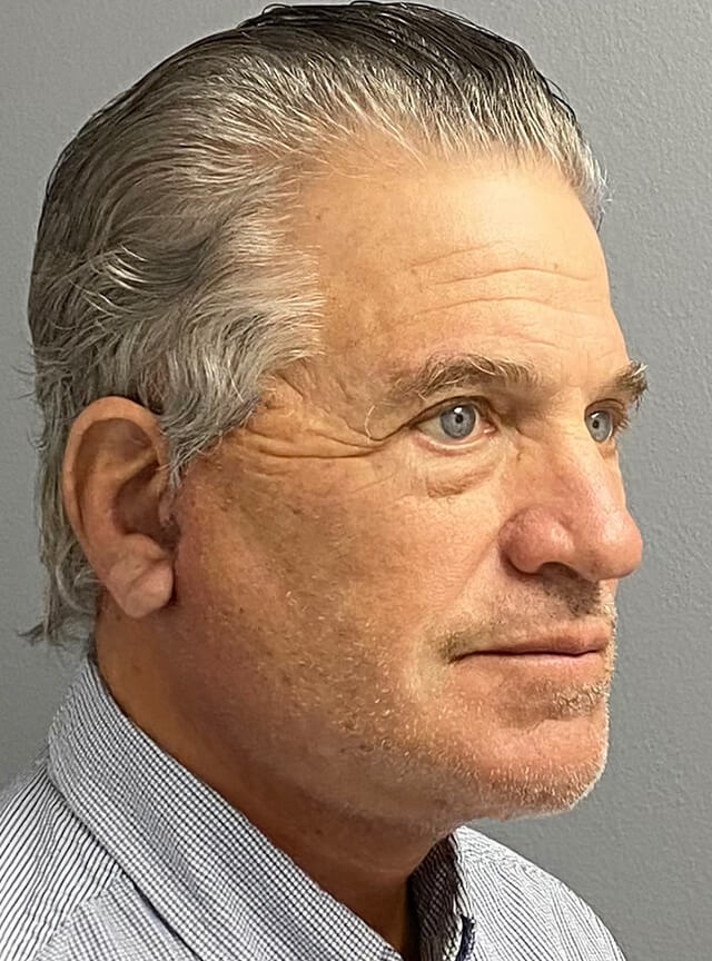 Case--6178 | After Facelift and Neck Lift 2