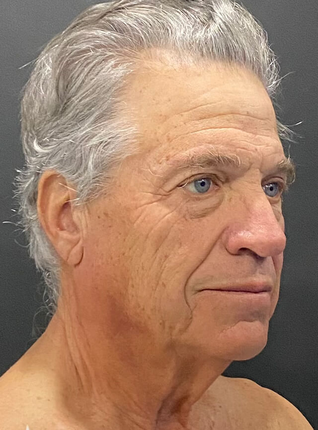 Case--6178 | Before Facelift and Neck Lift 2