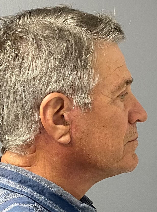 Case--6178 | After Facelift and Neck Lift 3