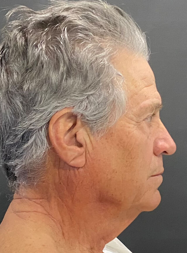 Case--6178 | Before Facelift and Neck Lift 3