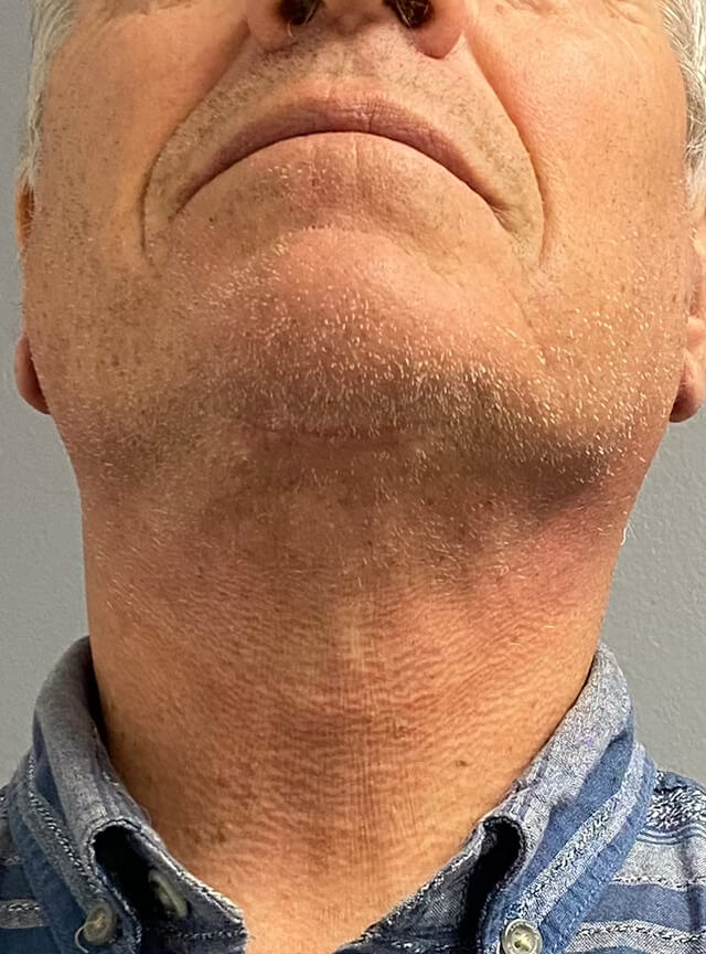 Case--6178 | After Facelift and Neck Lift 4