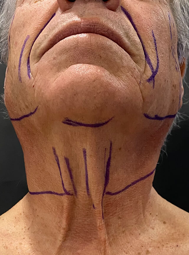 Case--6178 | Before Facelift and Neck Lift 4