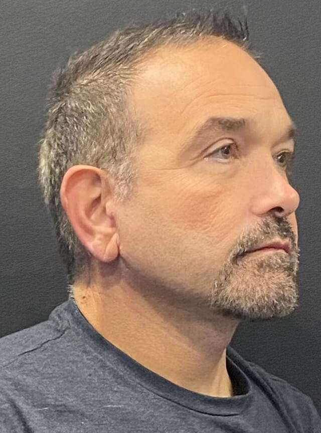 Case--4255 | After Facelift and Neck Lift