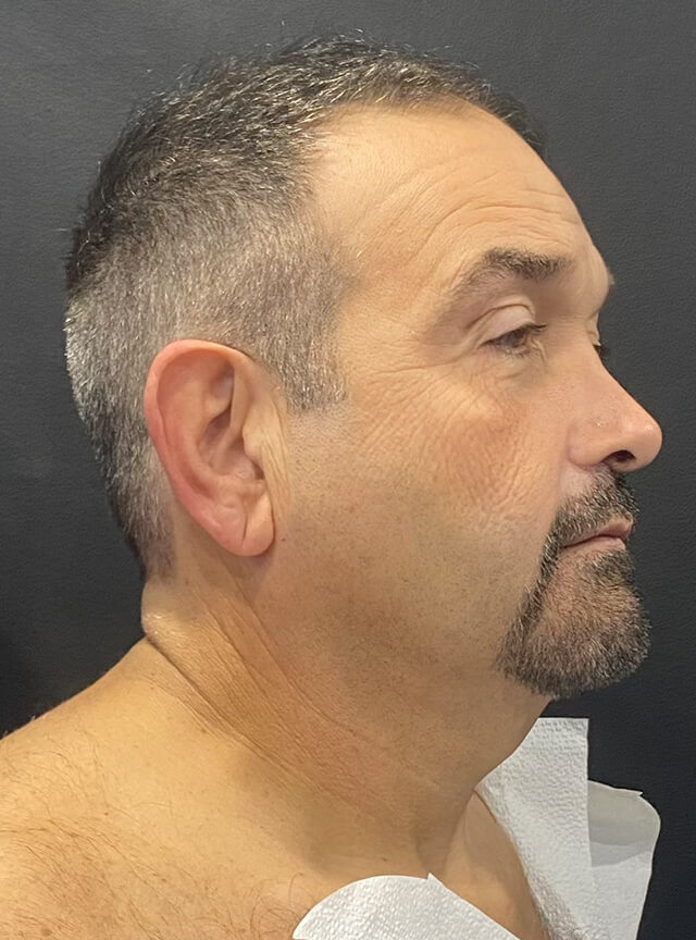 Case--4255 | Before Facelift and Neck Lift