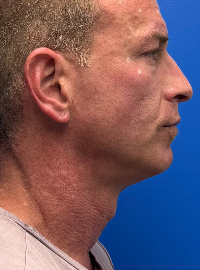 Case--9282 | After Liposuction