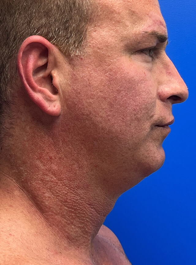 Case--9282 | Before Liposuction