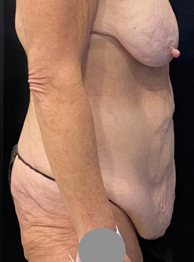 Case--4439 | Before Tummy Tuck 3