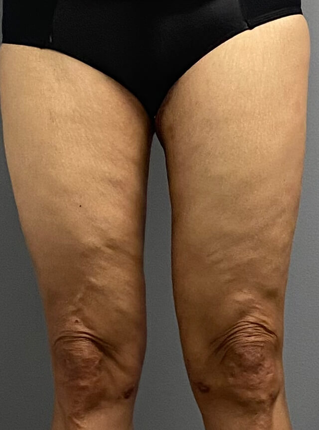Case--5564 | After Thigh Lift