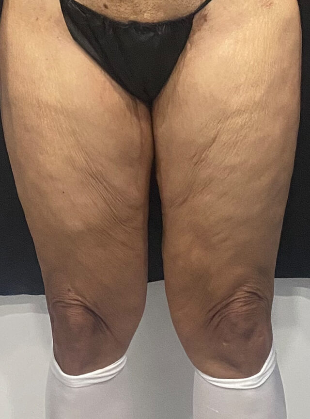 Case--5564 | Before Thigh Lift