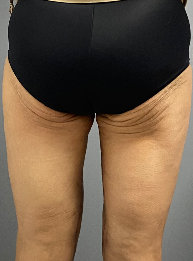 Case--5564 | After Thigh Lift 2
