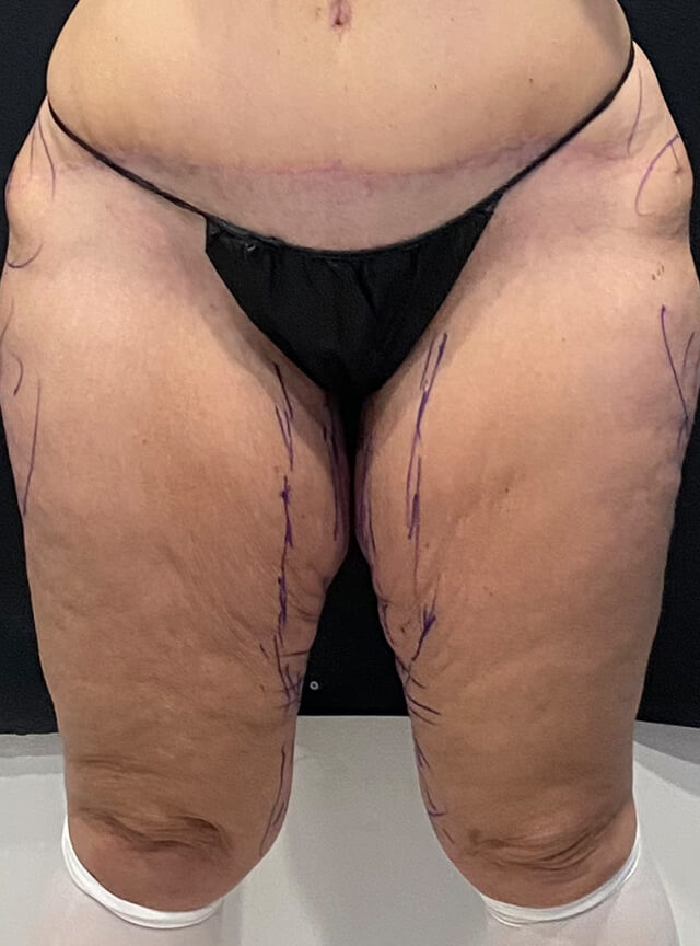 Case--4608 | Before Thigh Lift
