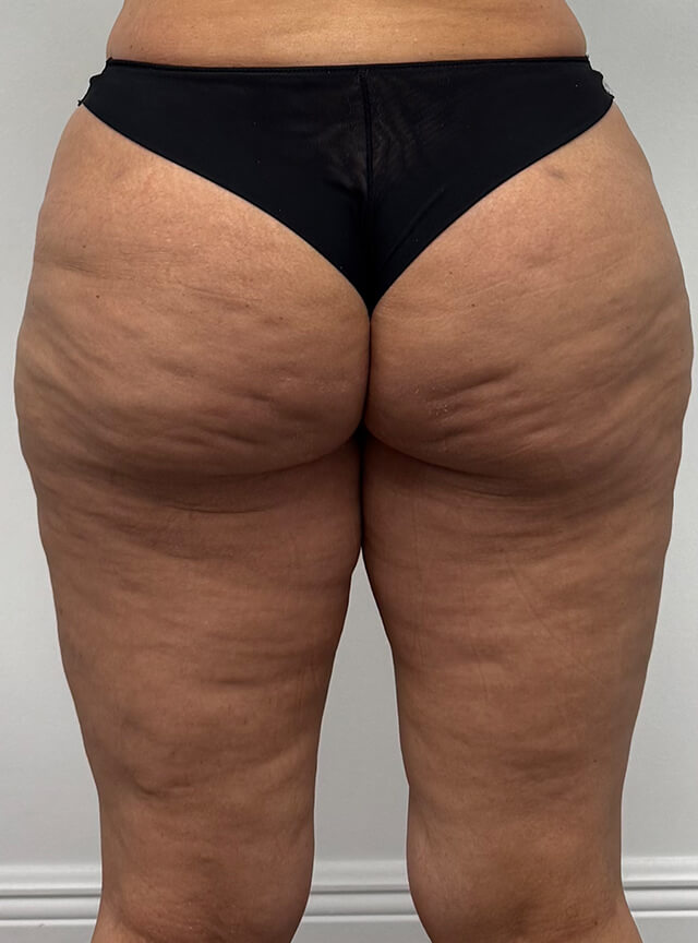 Case--4608 | After Thigh Lift 2