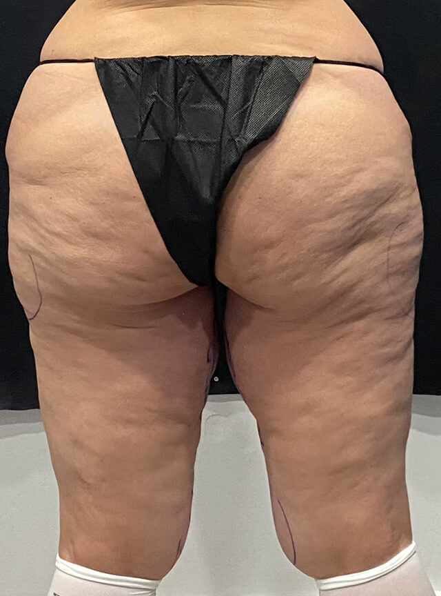Case--4608 | Before Thigh Lift 2