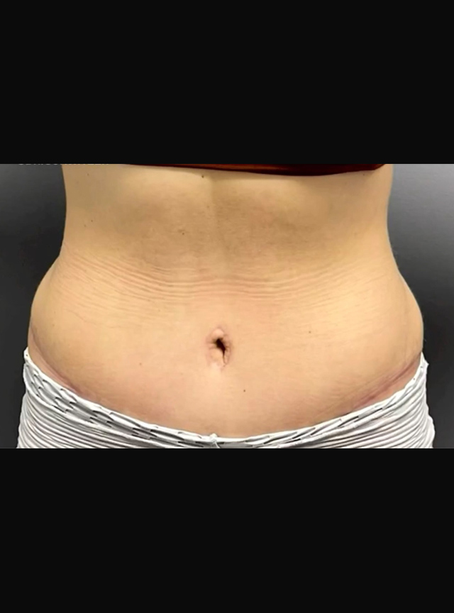 Case--2767 | After Tummy Tuck