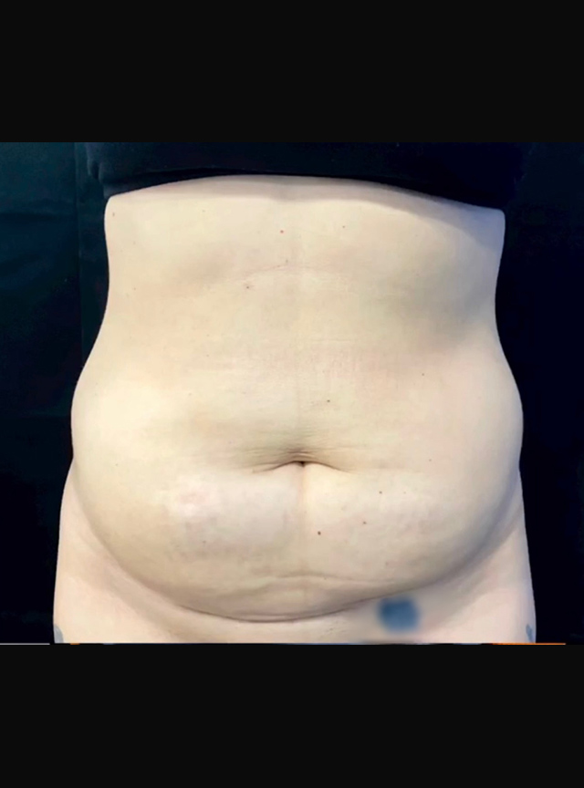 Case--2767 | Before Tummy Tuck
