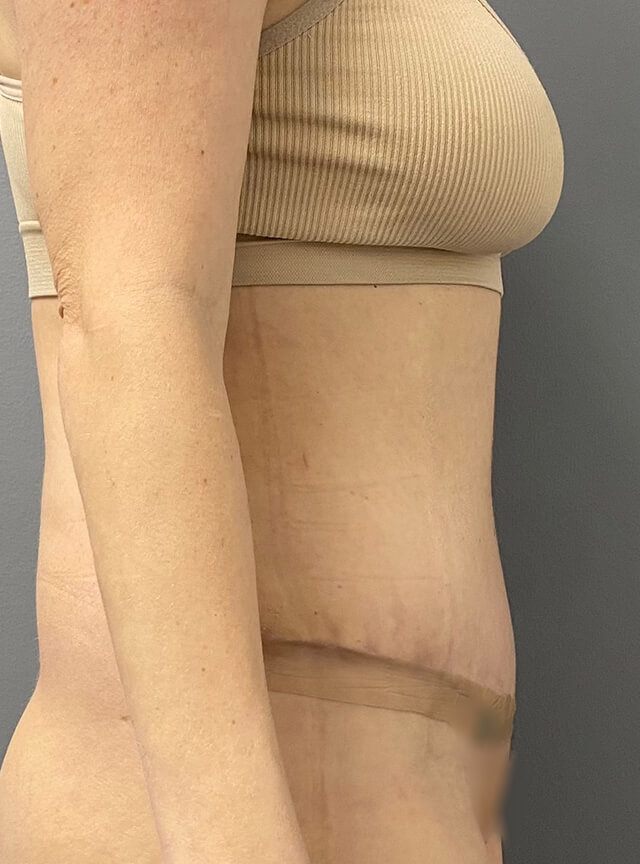 Case--2767 | After Tummy Tuck 2