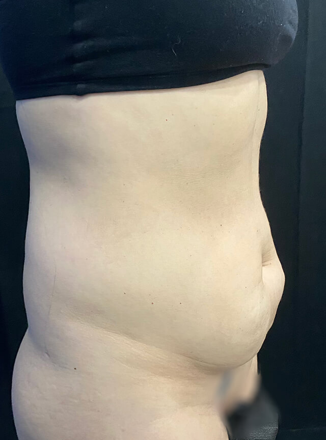 Case--2767 | Before Tummy Tuck 2