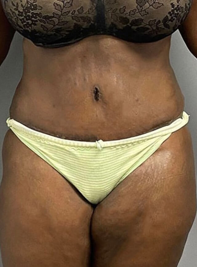 Case--2949 | After Tummy Tuck