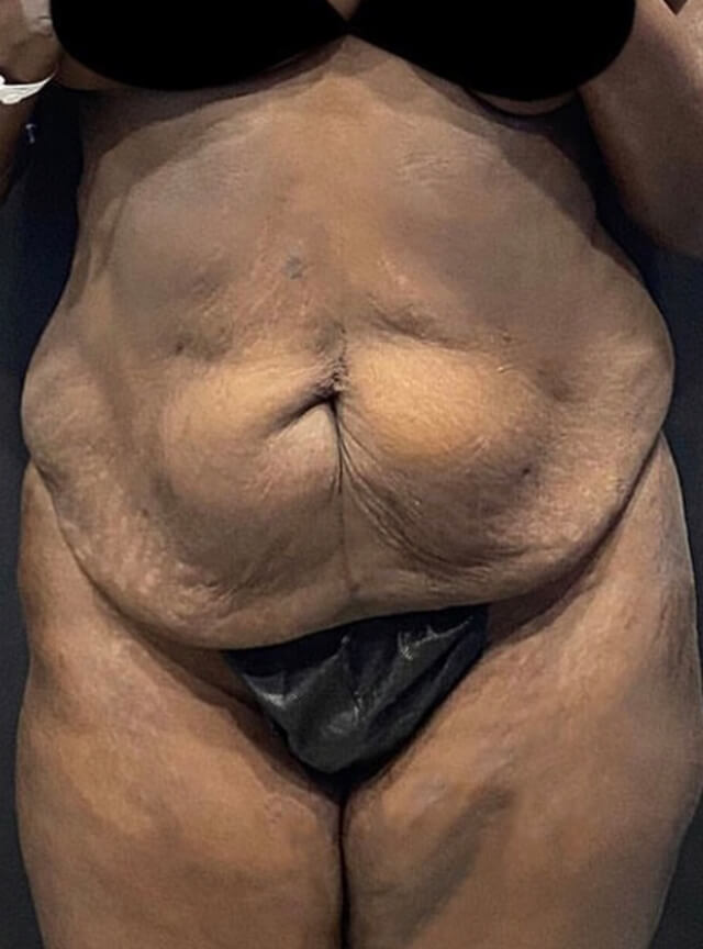 Case--2949 | Before Tummy Tuck