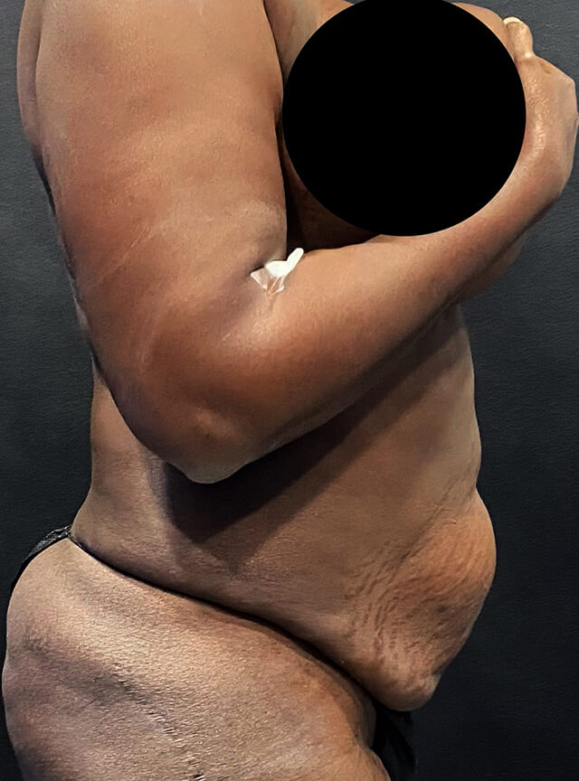 Case--2949 | Before Tummy Tuck 2