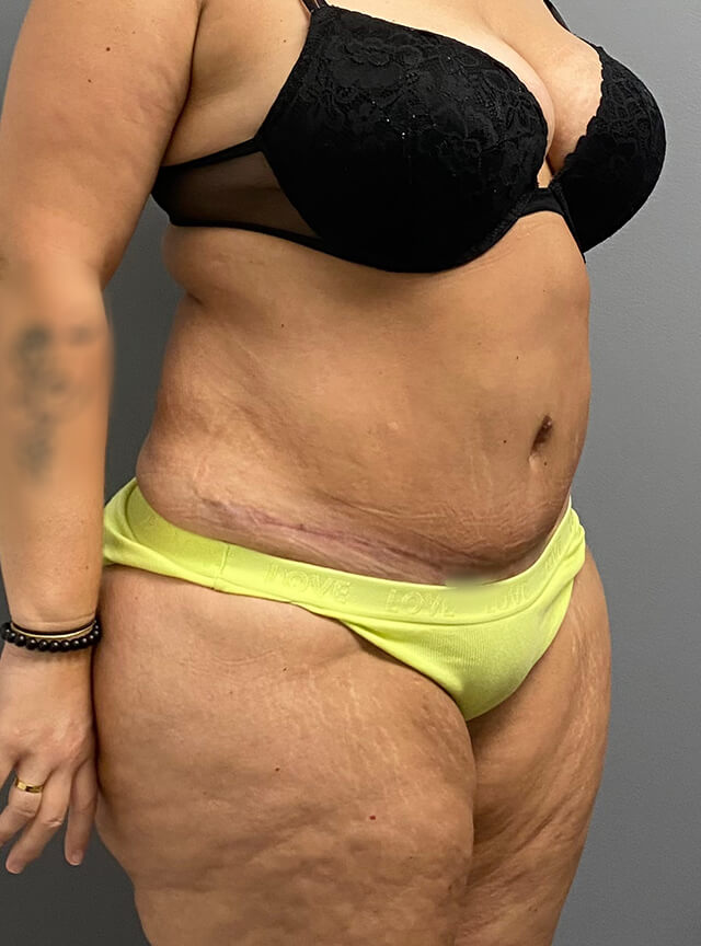 Case--7554 | After Tummy Tuck 2