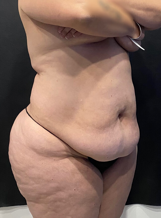 Case--7554 | Before Tummy Tuck 2