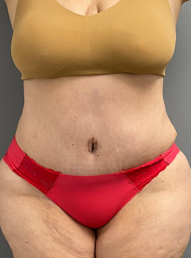 Case--7554 | After Tummy Tuck