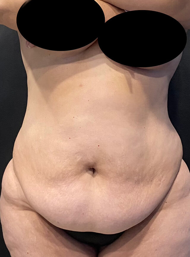 Case--7554 | Before Tummy Tuck