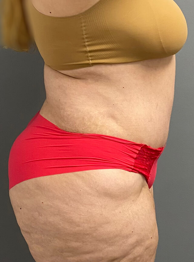 Case--7554 | After Tummy Tuck 3