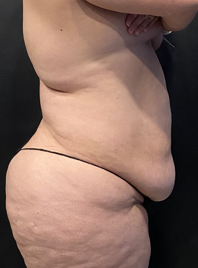 Case--7554 | Before Tummy Tuck 3