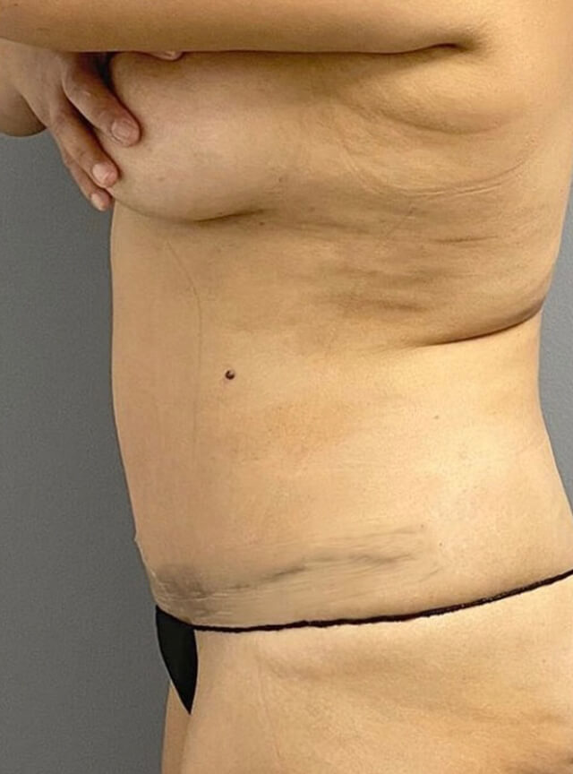 Case--3316 | After Tummy Tuck