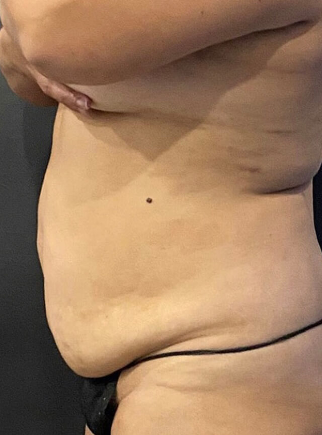 Case--3316 | Before Tummy Tuck
