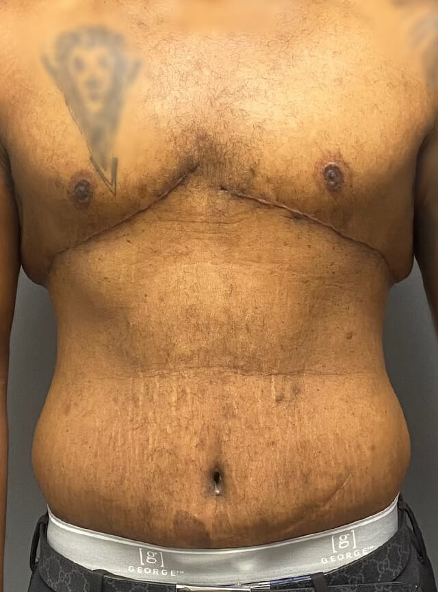 Case--1765 | After Tummy Tuck