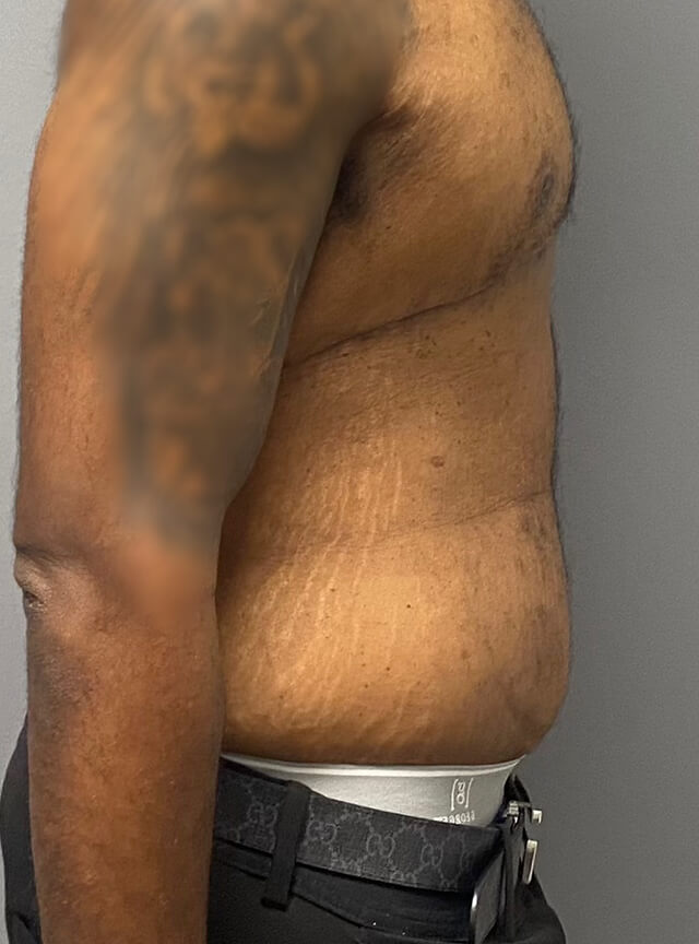 Case--1765 | After Tummy Tuck 2