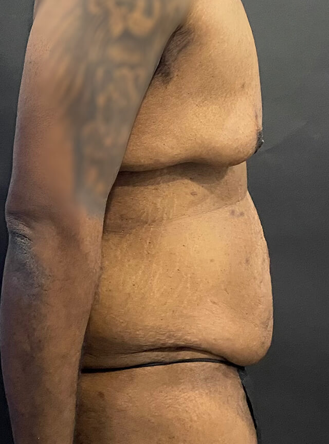 Case--1765 | Before Tummy Tuck 2