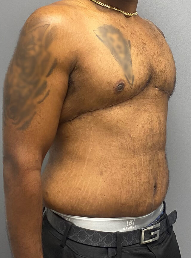 Case--6215 | After Gynecomastia 2