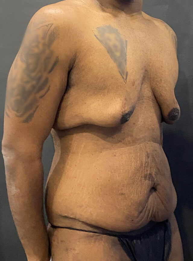 Case--6215 | Before Gynecomastia 2