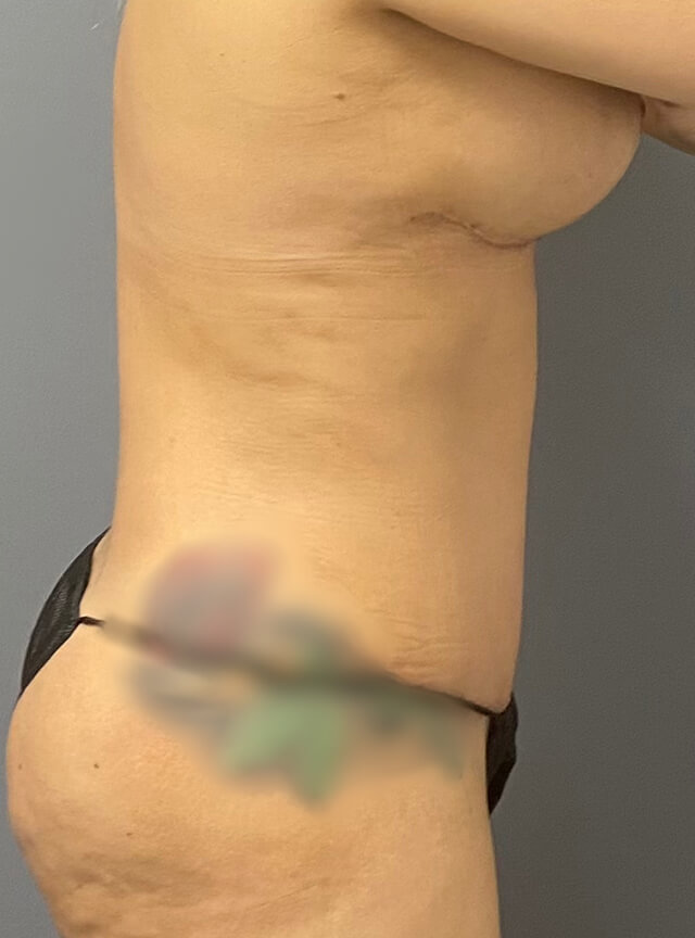 Case--5262 | After Tummy Tuck