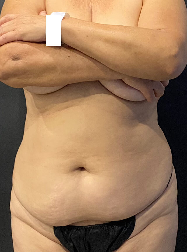 Case--2459 | Before Tummy Tuck
